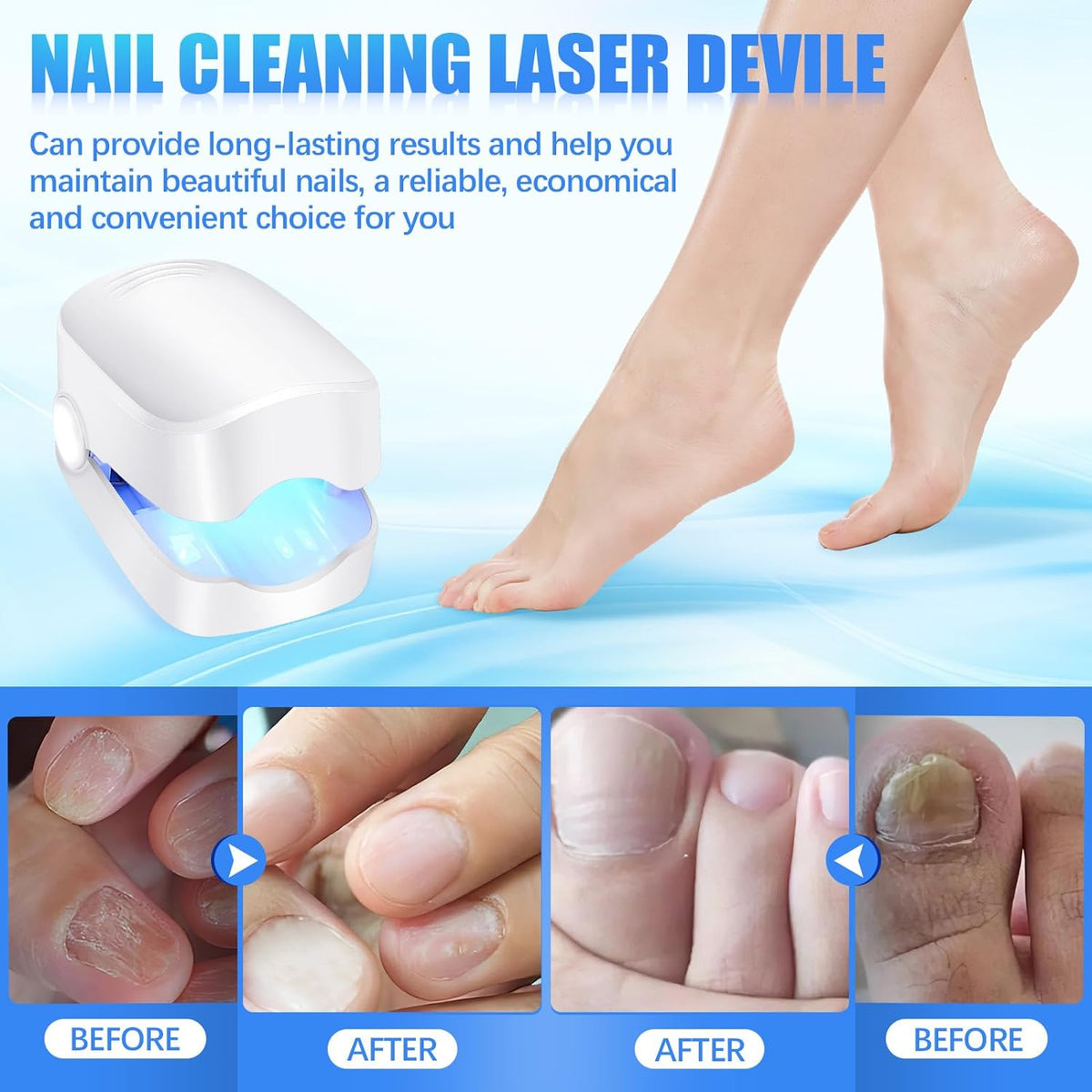 Rechargeable Nail Fungus Laser – Anti-Fungal Device Toenails, Hands & Feet (Home Use)